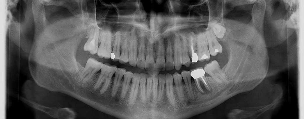 צילום שיניים פנורמי דיגיטלי